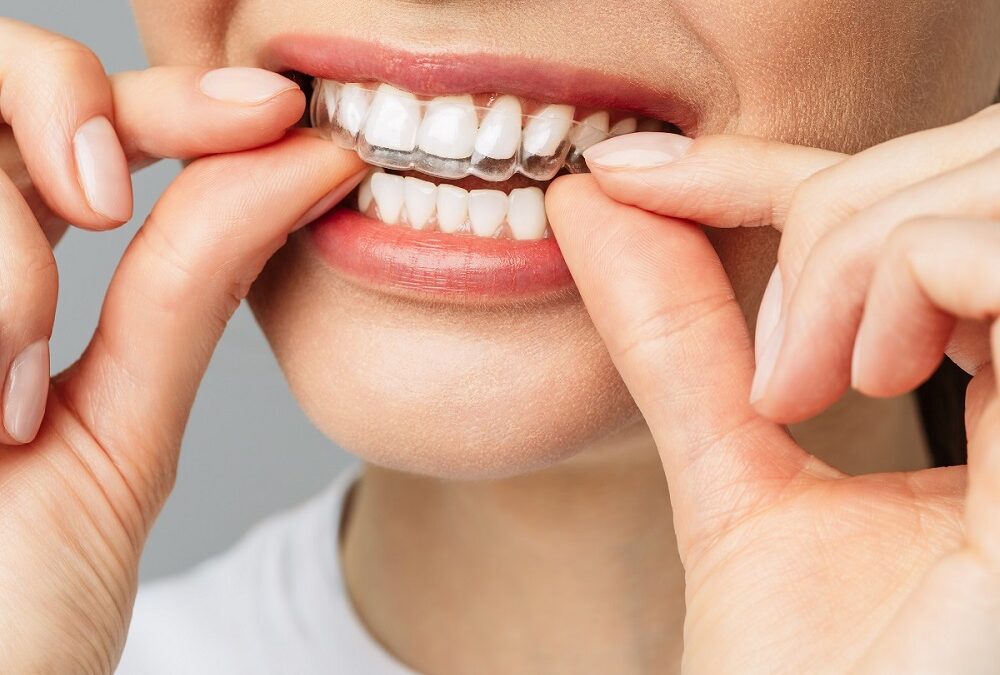 Invisalign treatment in Marvin NC: What to Expect