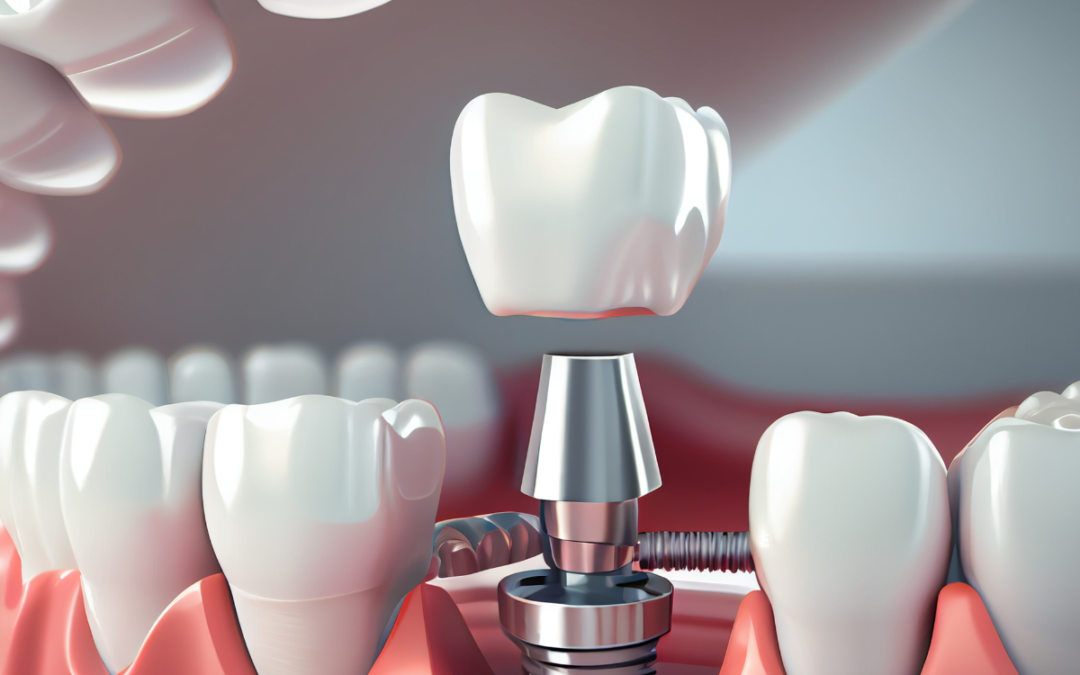 Dental Implants in Marvin NC: Immediate vs. Delayed Placement