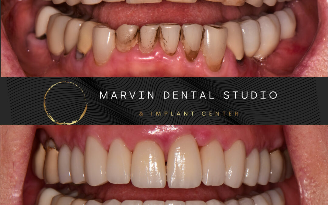 Marvin’s Top Cosmetic Dentist Will Perfect Your Smile