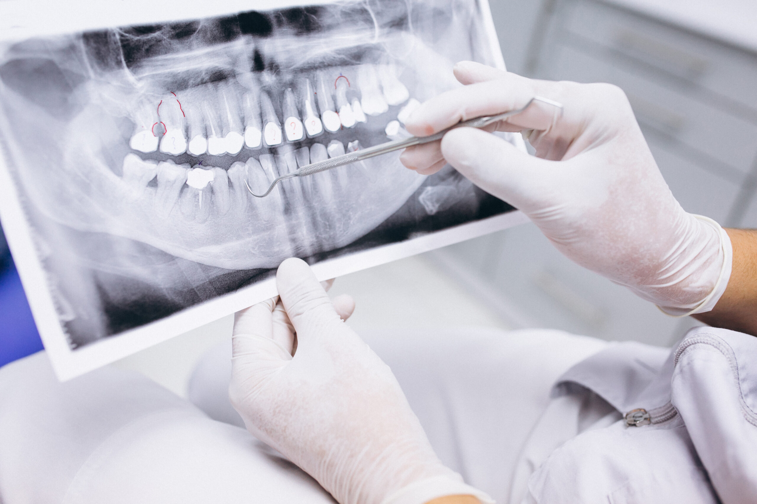 X ray of patient's teeth before dental implant