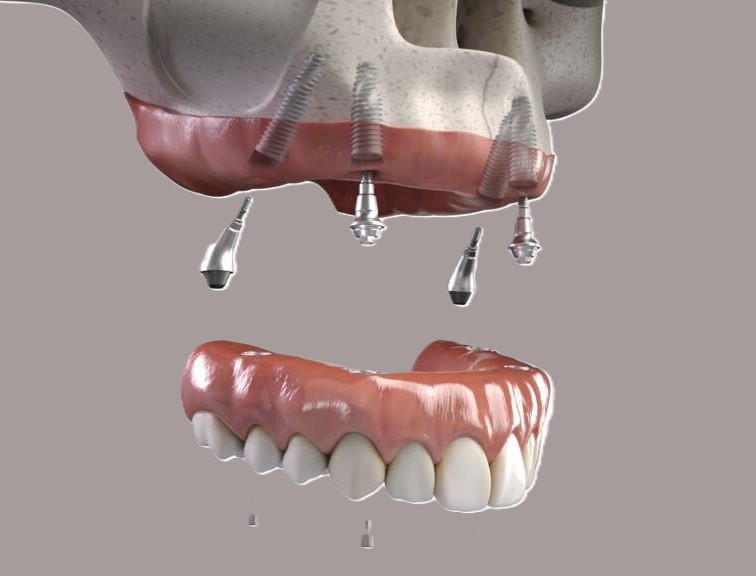 All on 4 dental implants recovery in Marvin and Waxhaw NC